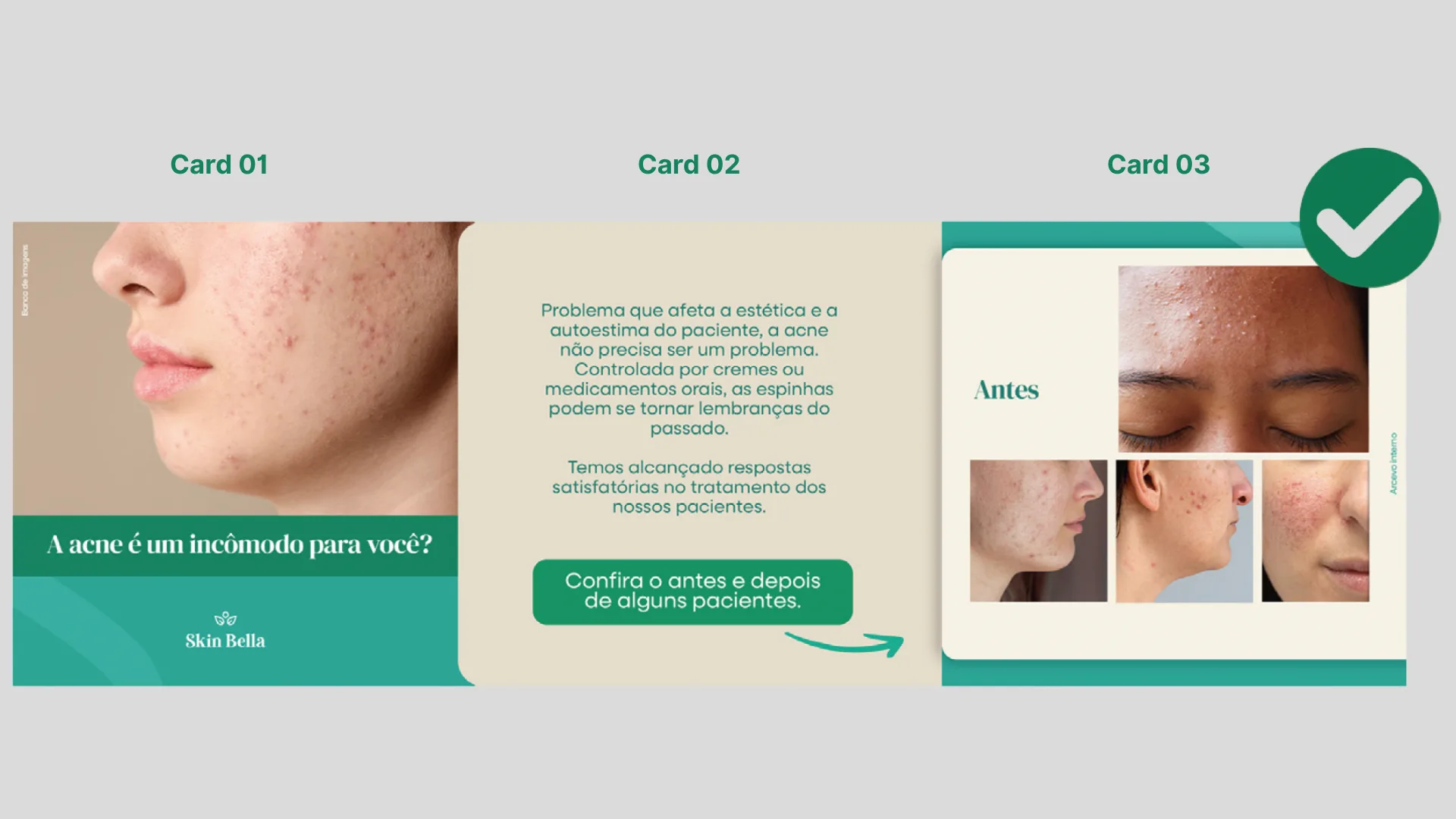 Cards de uma publicação para as redes sociais com foco no tratamento da acne, exibindo imagens do rosto de pacientes antes da intervenção. O conteúdo destaca a importância de resultados reais e comunicação ética com imagens ilustrativas, respeitando as diretrizes do CFM.